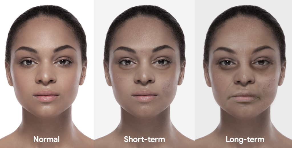 A woman showing the short and long-term affects of sleep deprivation, including eye bags, spots, wrinkles and dry skin.